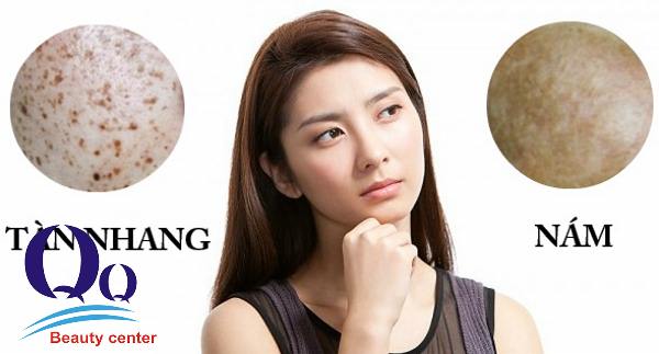 Cách phân biệt giữa tàn nhang và nám