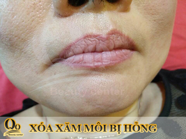 Xóa xăm môi bằng cách nào tốt Không đau Giá rẻ BVTM Kangnam