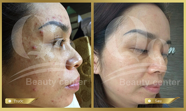 Hình ảnh Trước và Sau trị mụn hiệu quả 